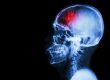8 Things You Should Know After Stroke | Reliant at Home Care