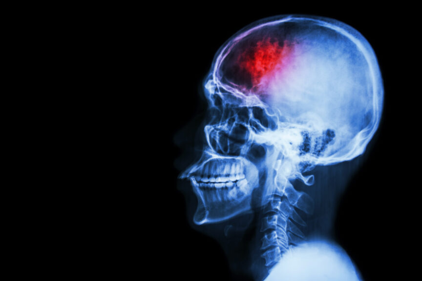 8 Things You Should Know After Stroke | Reliant at Home Care